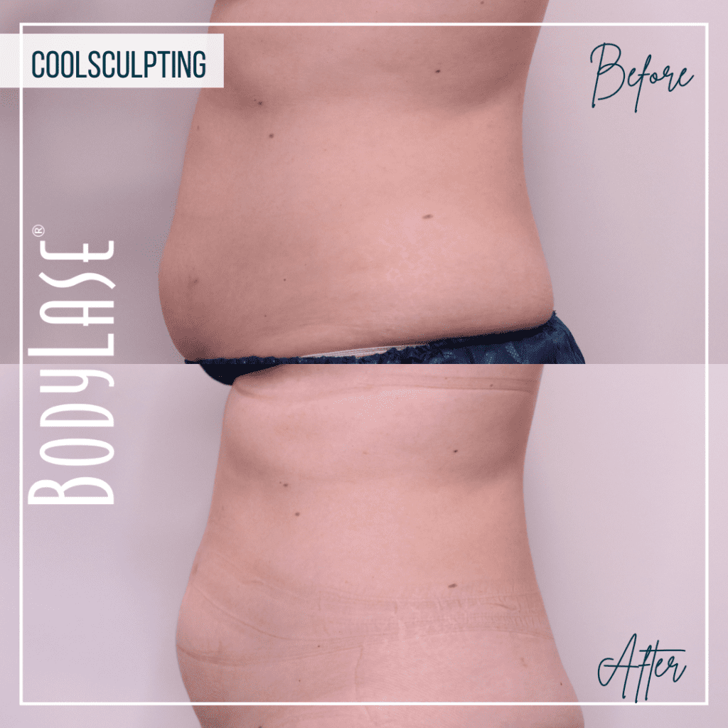 CoolSculpting Elite Before and After: A Complete Guide to the Fat Freezing Procedure 3