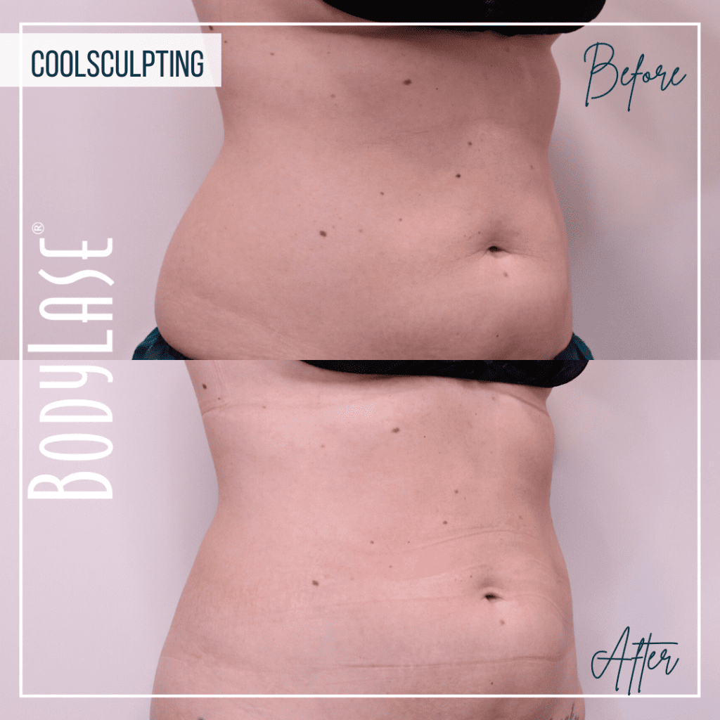 CoolSculpting Elite Before and After: A Complete Guide to the Fat Freezing Procedure 4