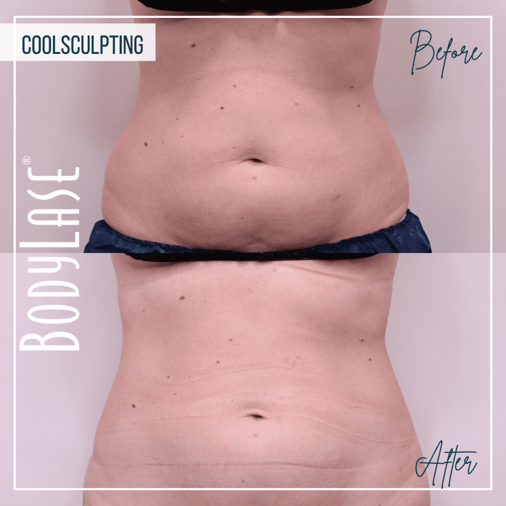 CoolSculpting Elite Before and After: A Complete Guide to the Fat Freezing Procedure 5
