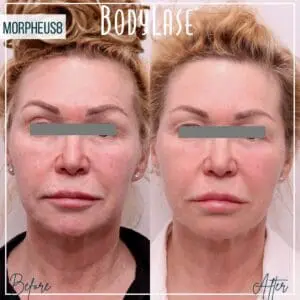 Morpheus8 Before and After