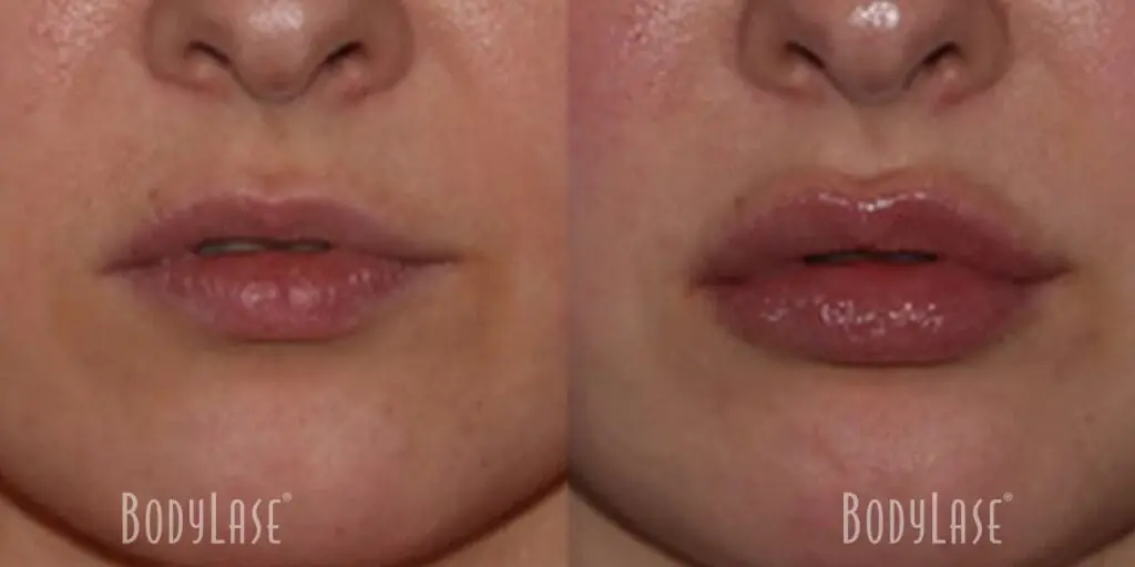 Lip Flip vs Filler 1 Lip Filler before and after