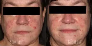 Before and After Facial