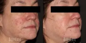 Before and After Facial