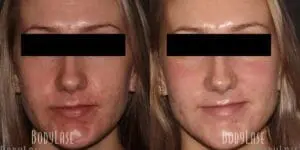 Before and After Facial