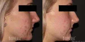 Before and After Facial
