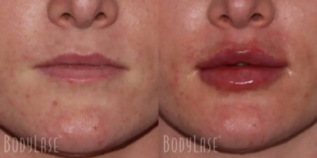 Before and After Lip Filler