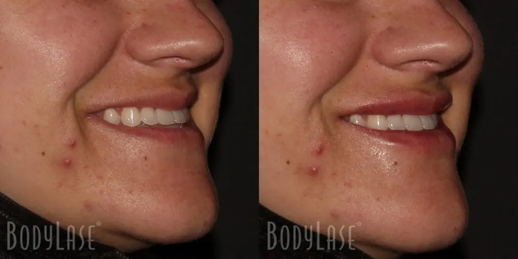 Before and after lip filler
