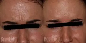 Botox before and after
