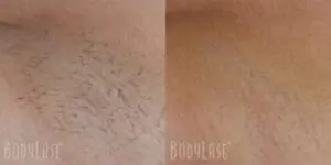 Laser Hair Removal