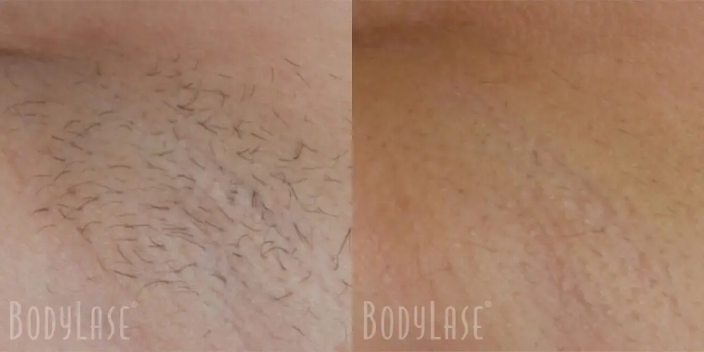 Laser Hair Removal