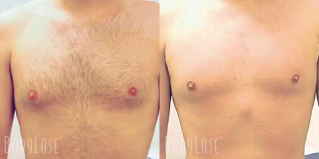 Understanding Our Laser Hair Removal Guarantee 3