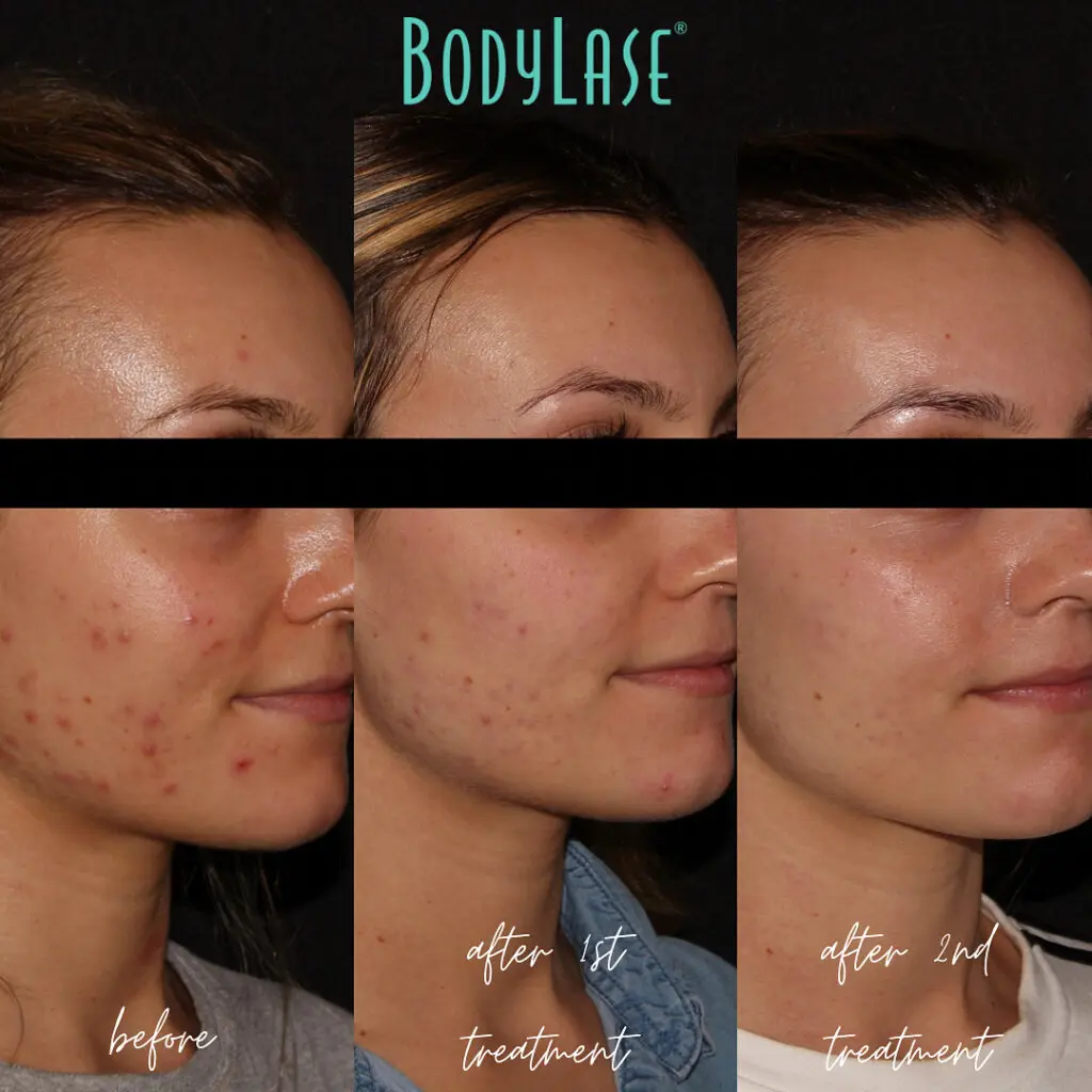 Before and After Morpheus8