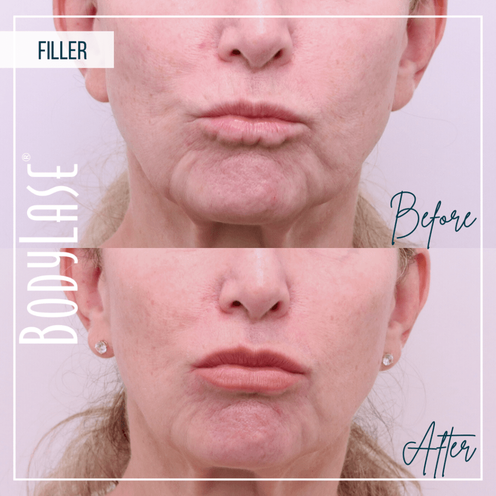Before and After Lip Filler