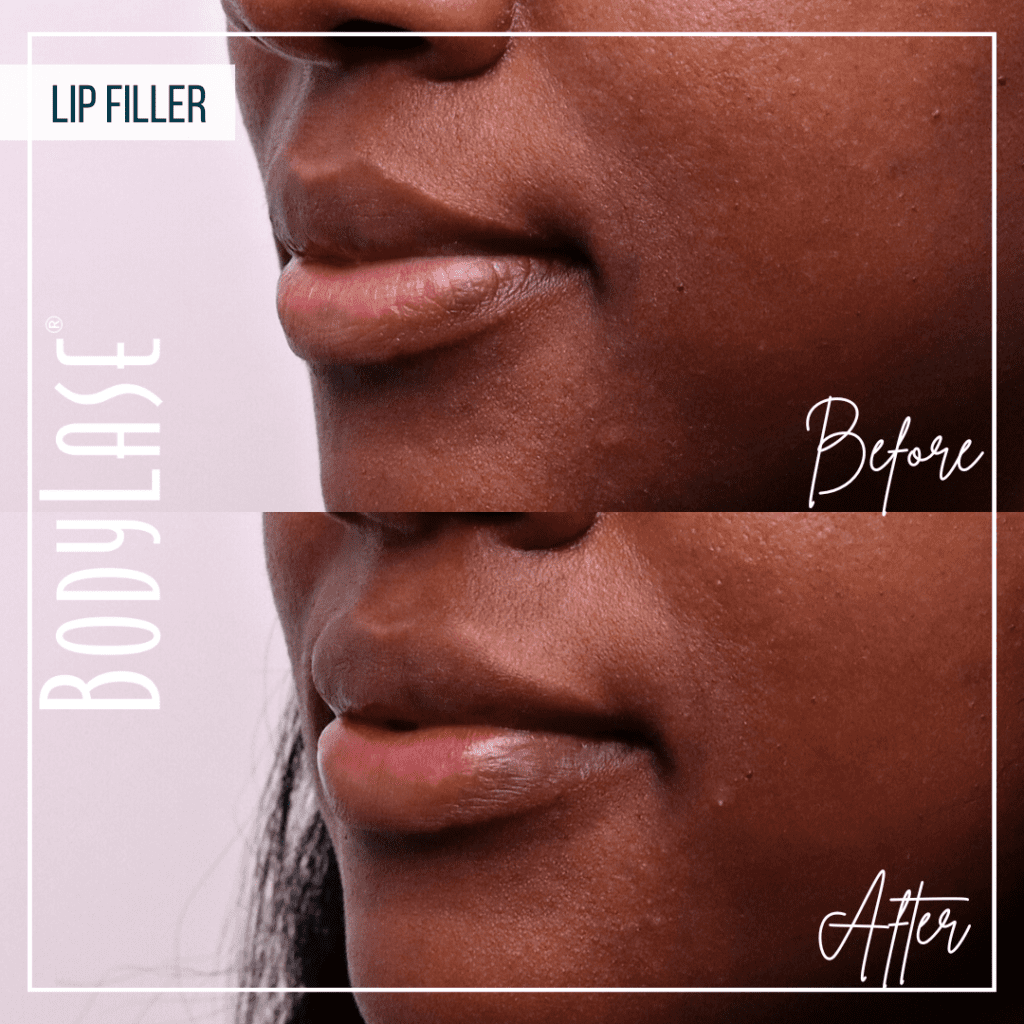 Before and After Lip Filler