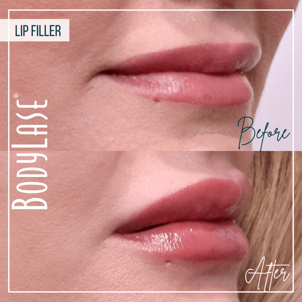 Before and After Lip Filler