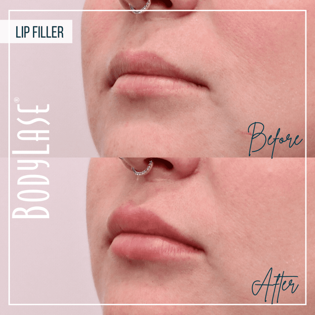 Before and After Lip Filler