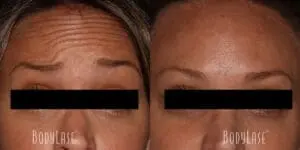 Botox in forehead