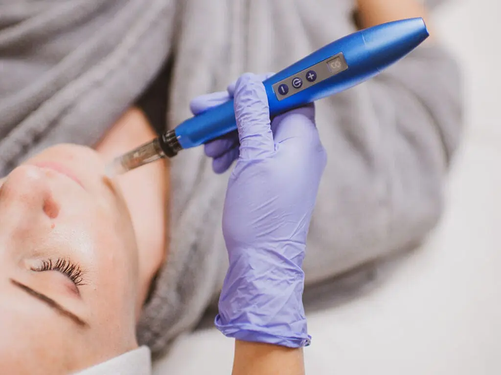Microneedling treatment