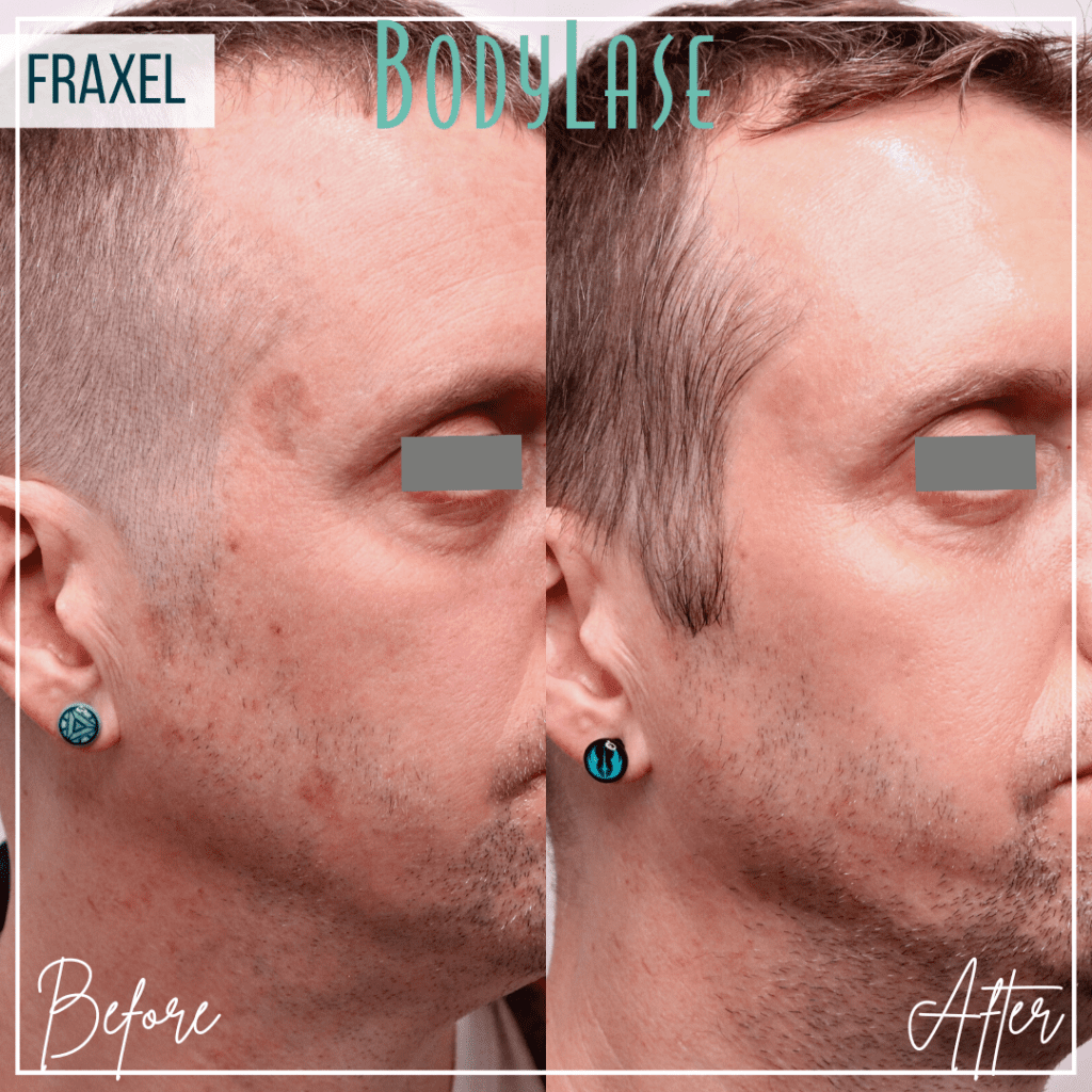 All About Laser Skin Resurfacing: How Does Fraxel Work? 2