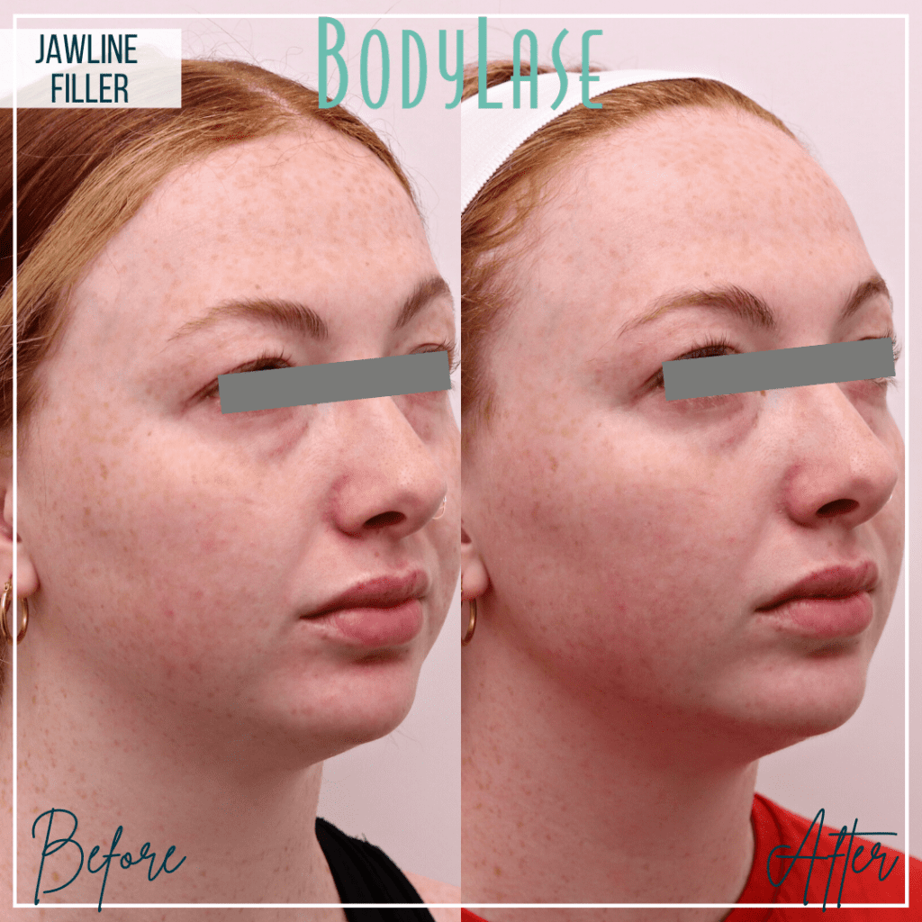 Jawline Filler Before and After