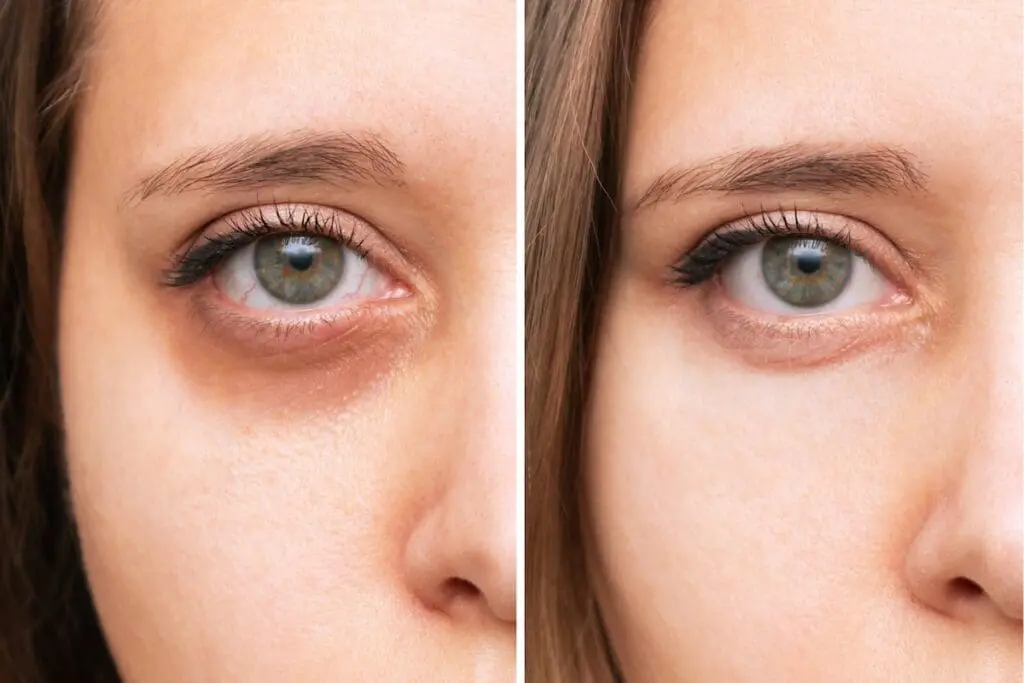 How to Get Rid of Dark Circles and Puffiness Under the Eyes 2 Dark Circles before and after