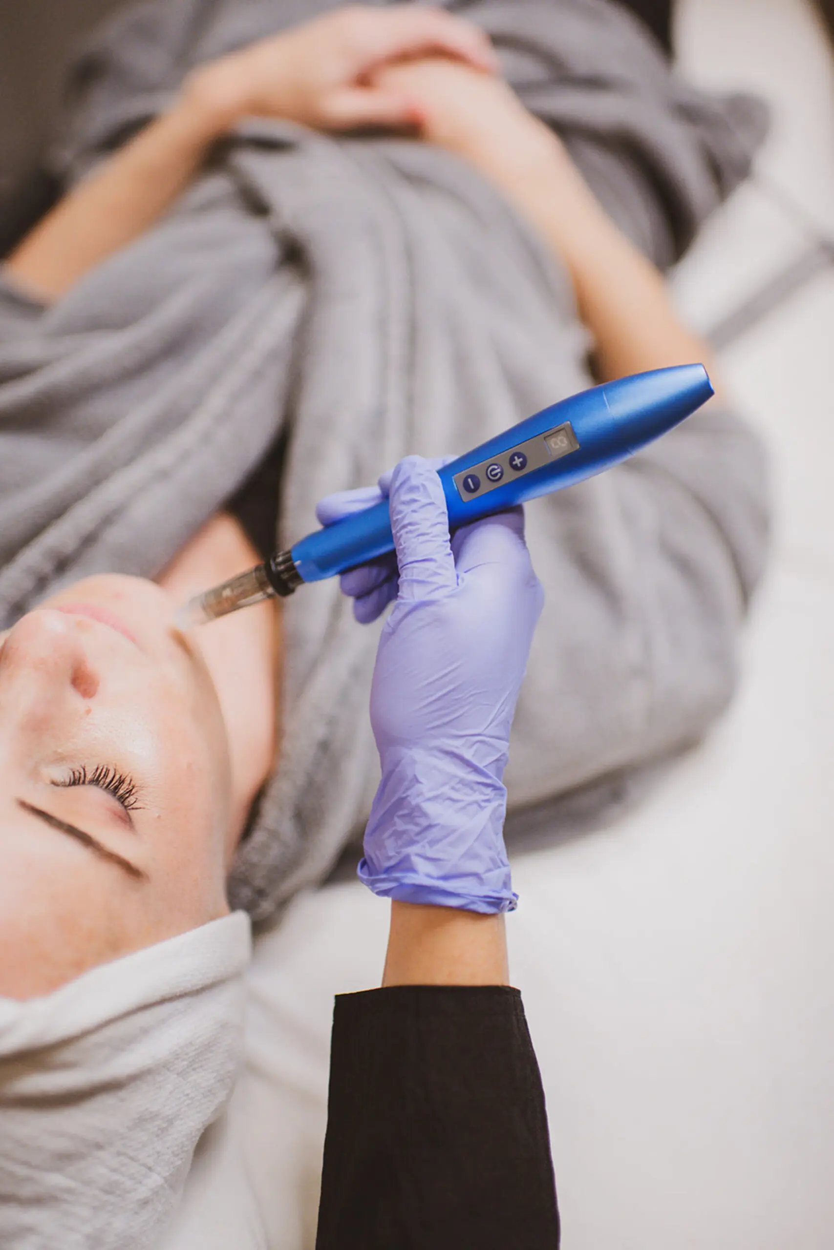 Microneedling