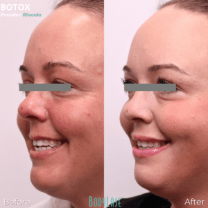 Botox before and after