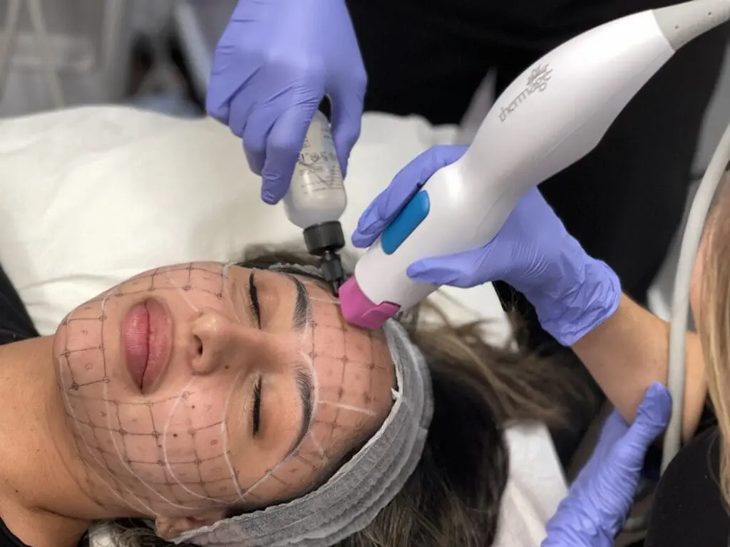 Regenerative Aesthetics Is the Future… And It Is Already Here 3 Thermage Treatment