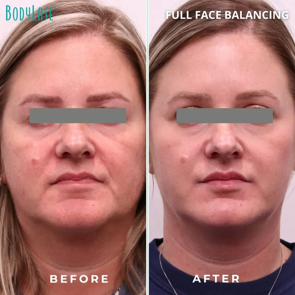 Face Filler
