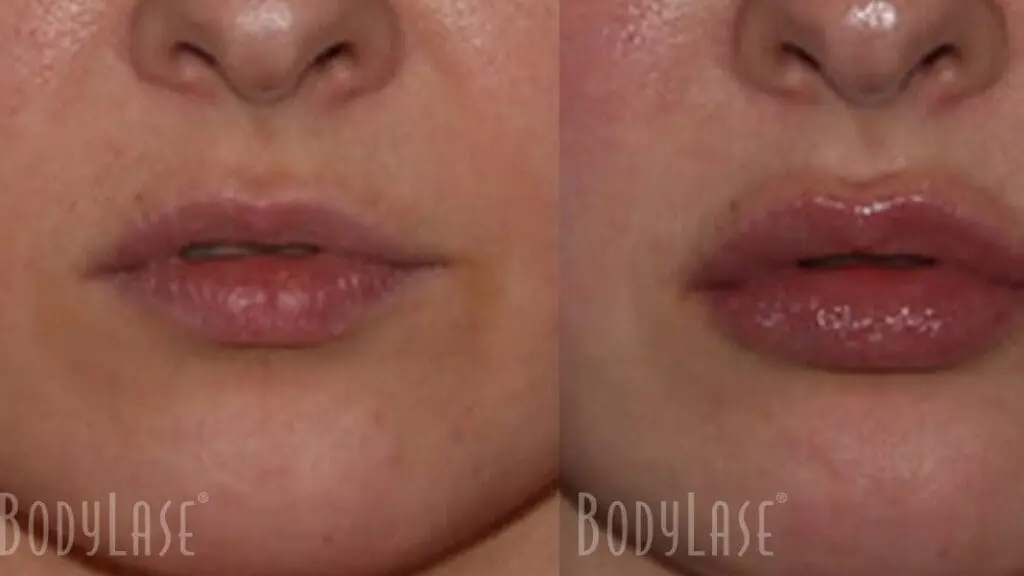 before and after lip filler