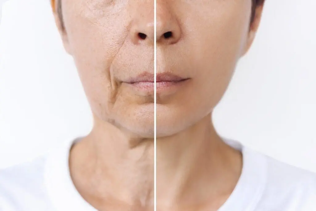 What Is Collagen? 2 Collagen before and after