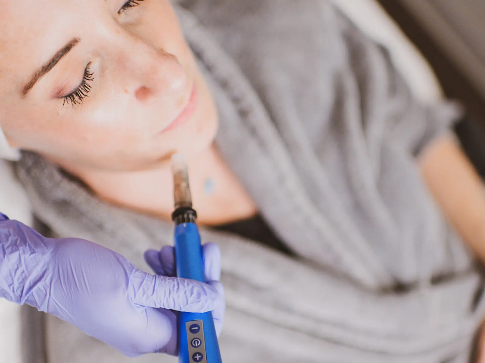 Microneedling