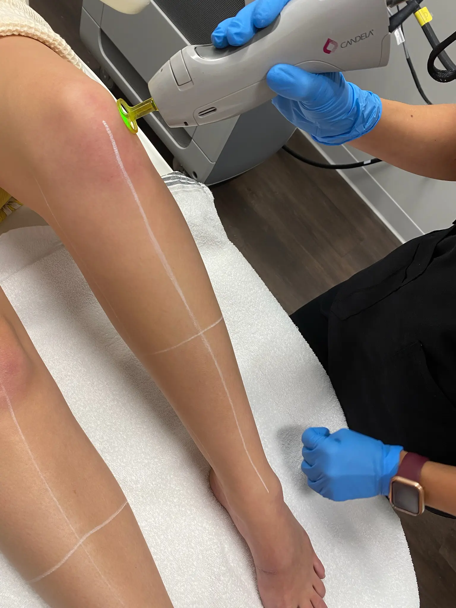 Laser Hair Removal