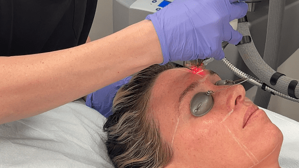 Fraxel® Laser Skin Resurfacing in Raleigh, Cary, and Clayton, NC 1 Fraxel Laser Resurfacing