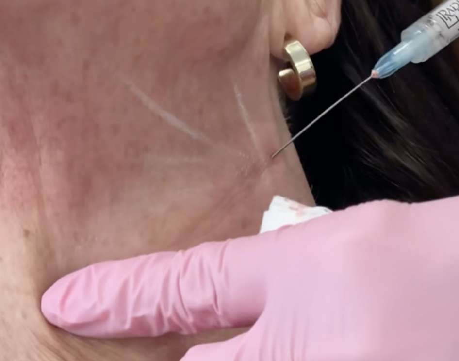 What is Hyperdilute Radiesse? 2 Hyperdiluate Radiesse