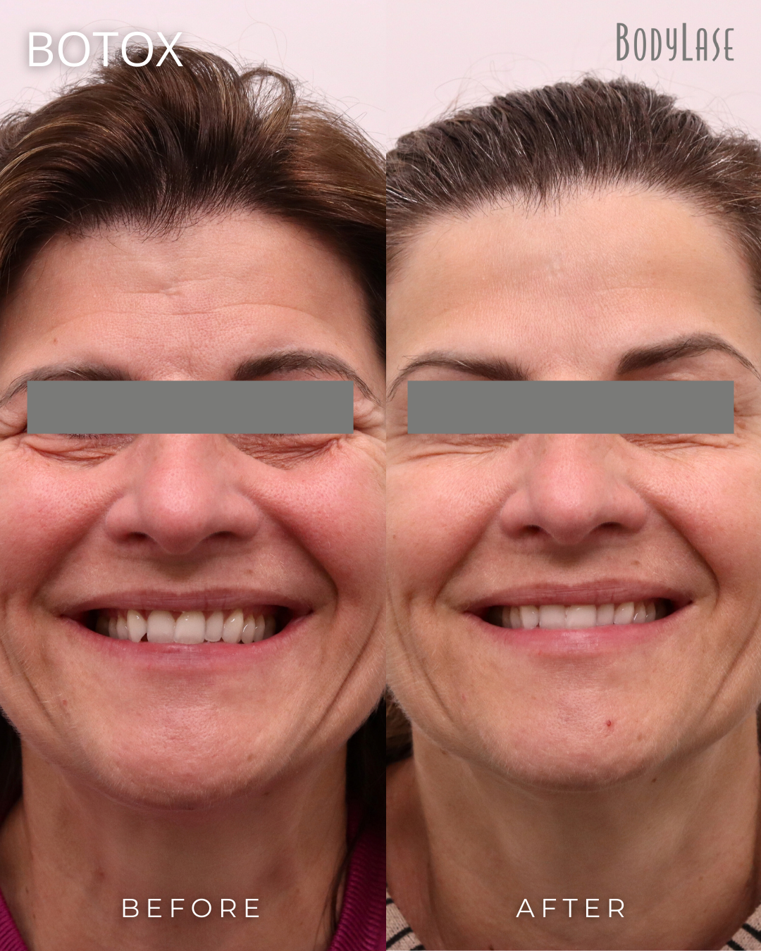 botox before & after