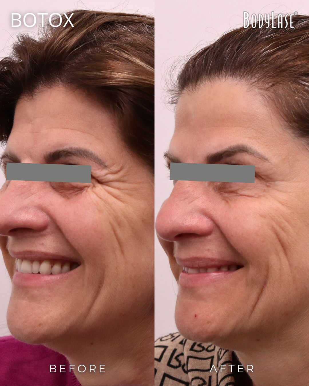 botox before & after