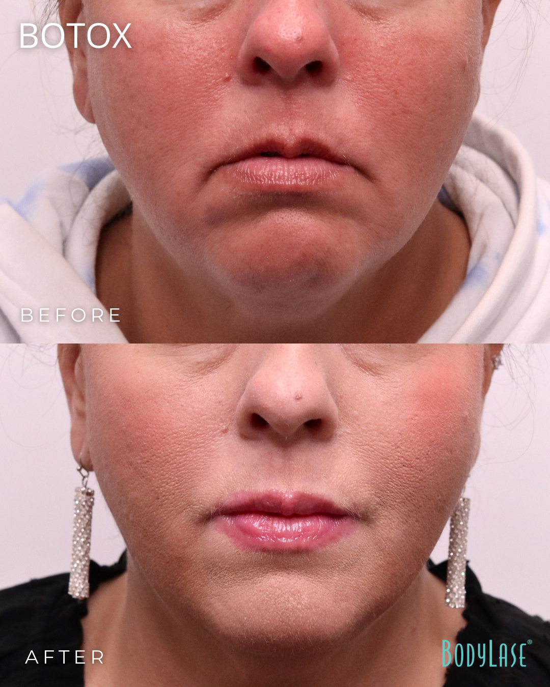 botox before & after