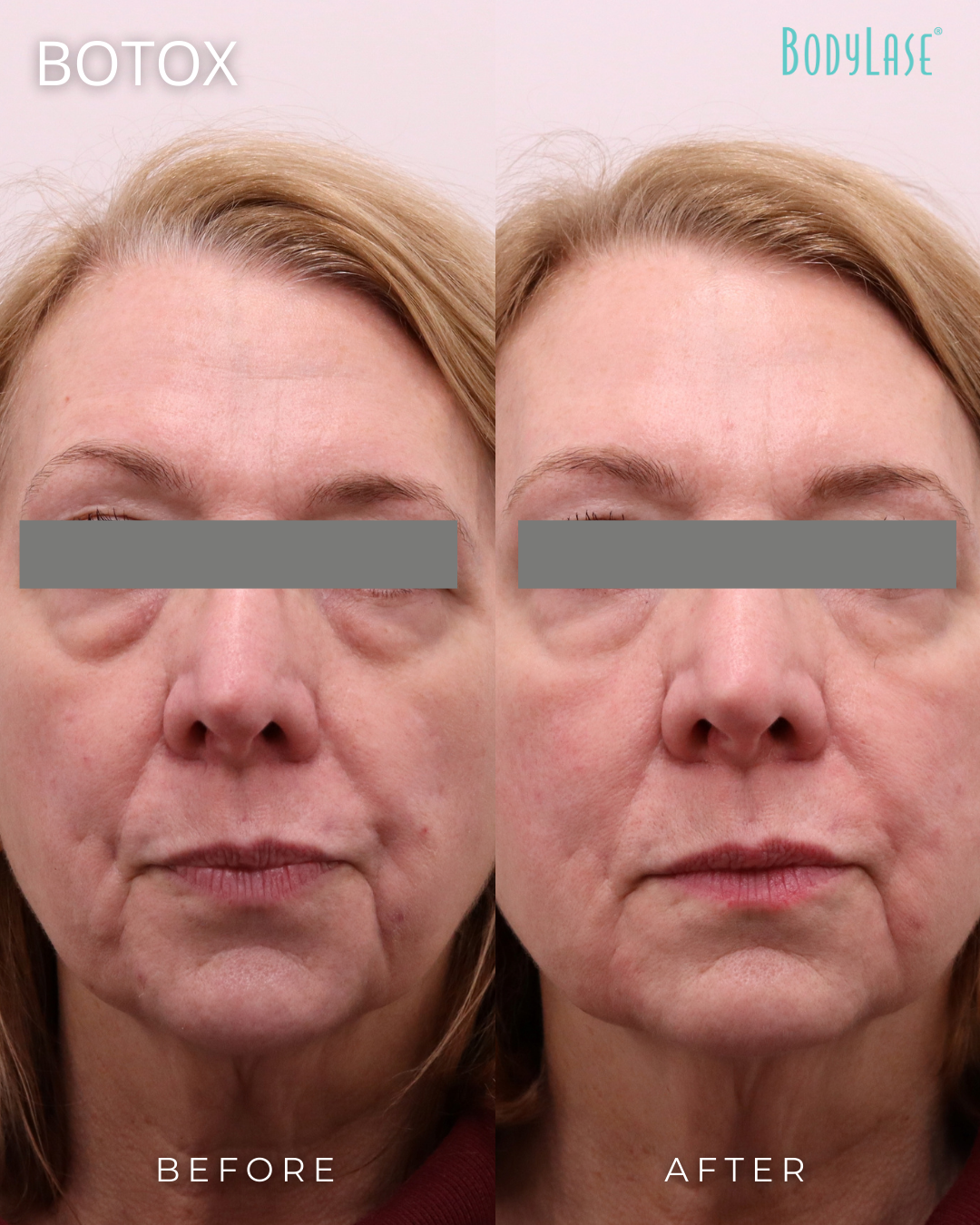 botox before and after