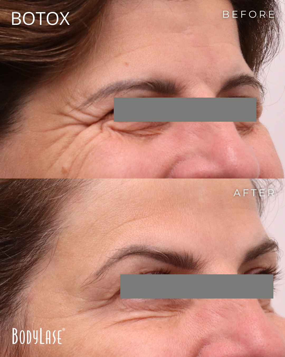 botox before & after