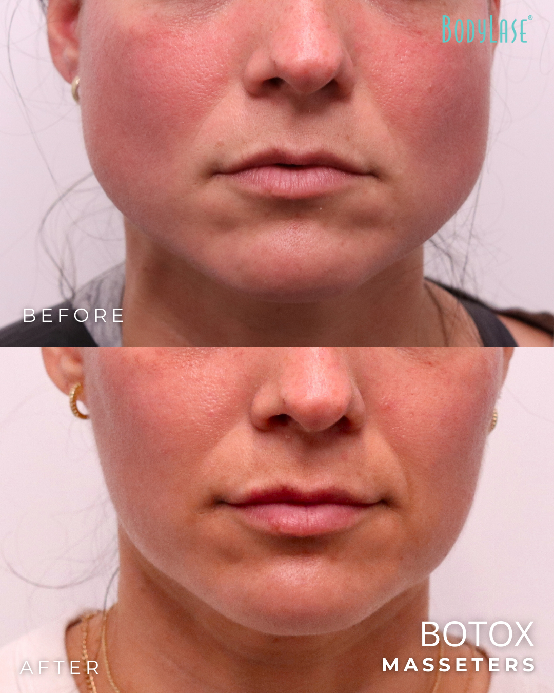 botox before & after