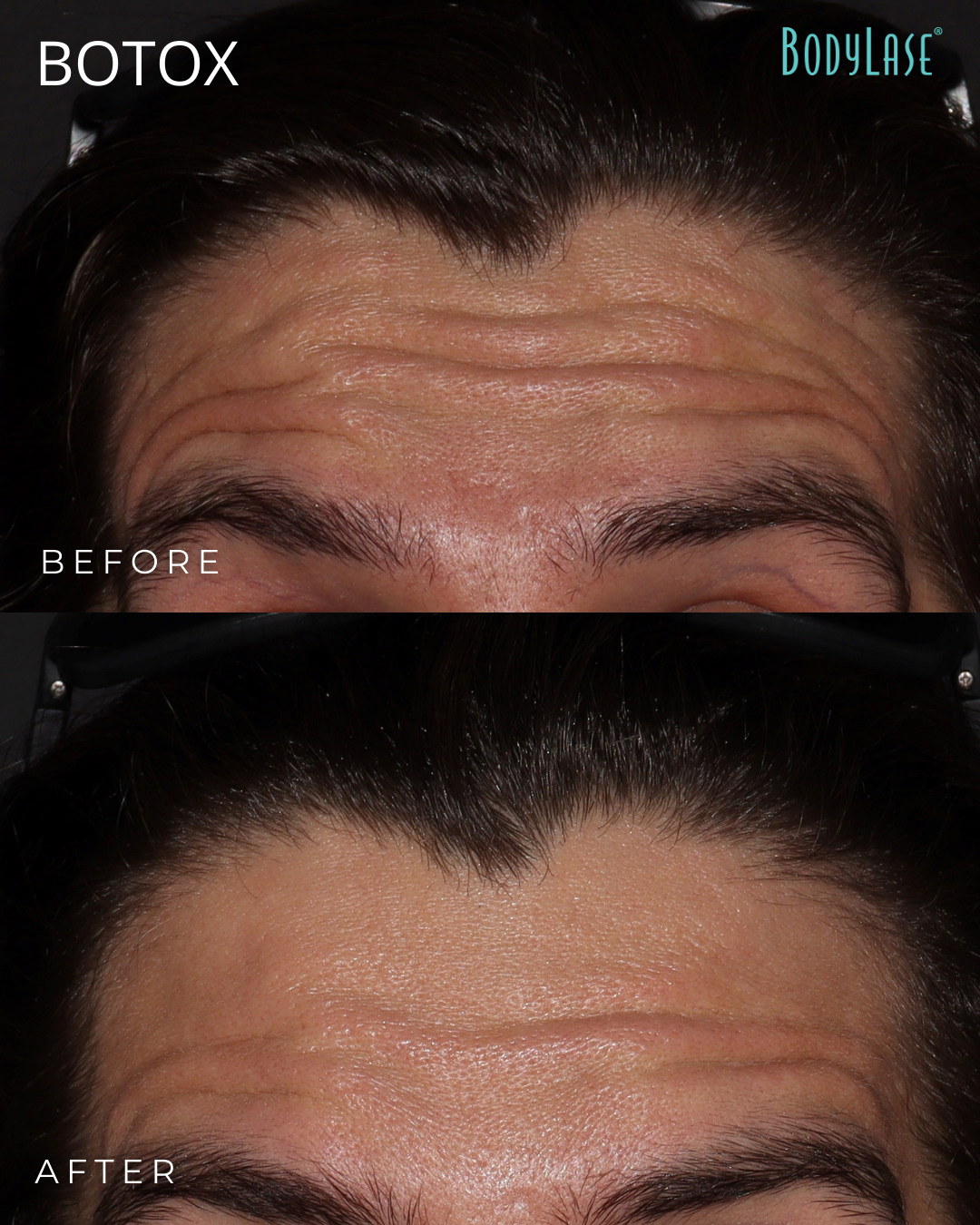 botox before & after
