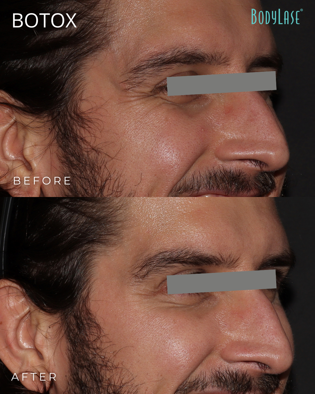 botox before & after