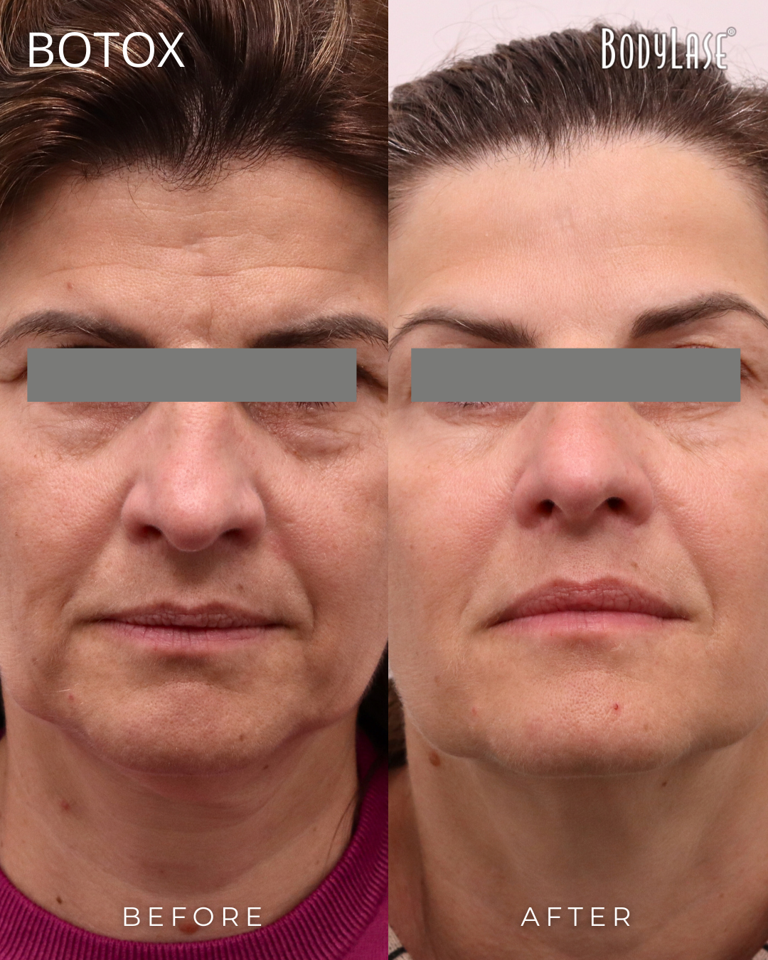 botox before & after