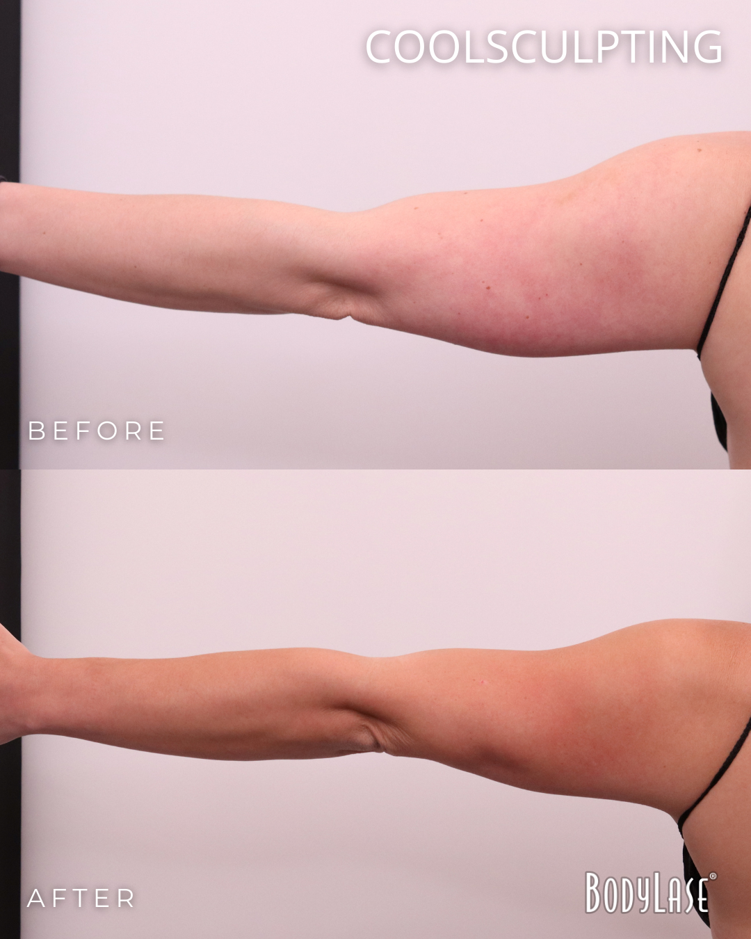 botox before & after