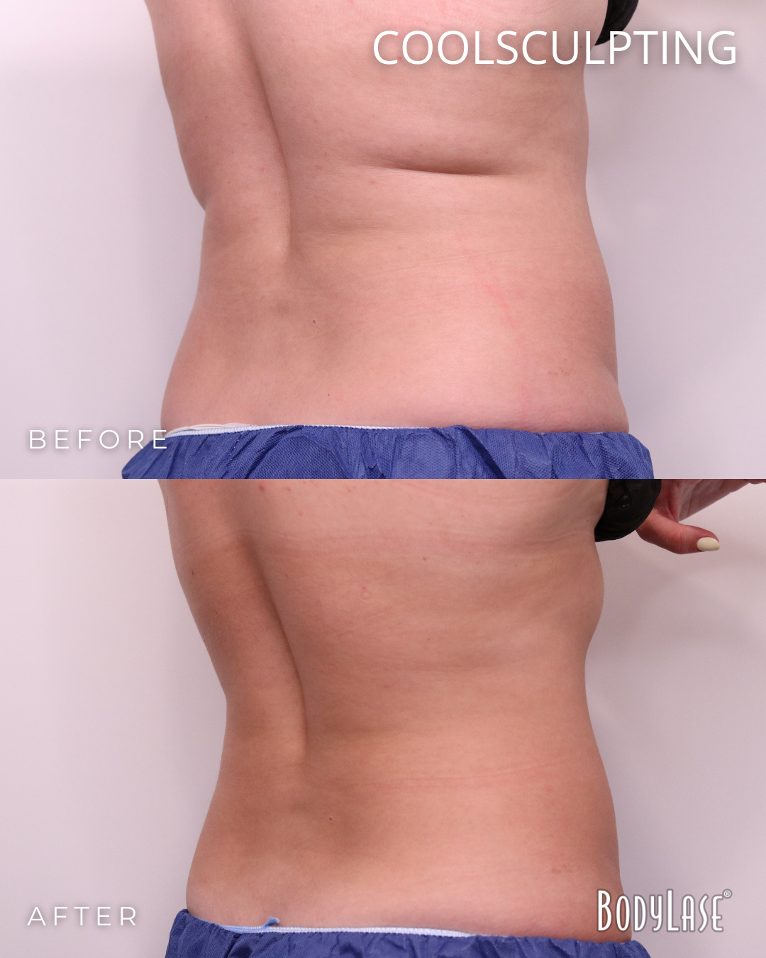 botox before & after