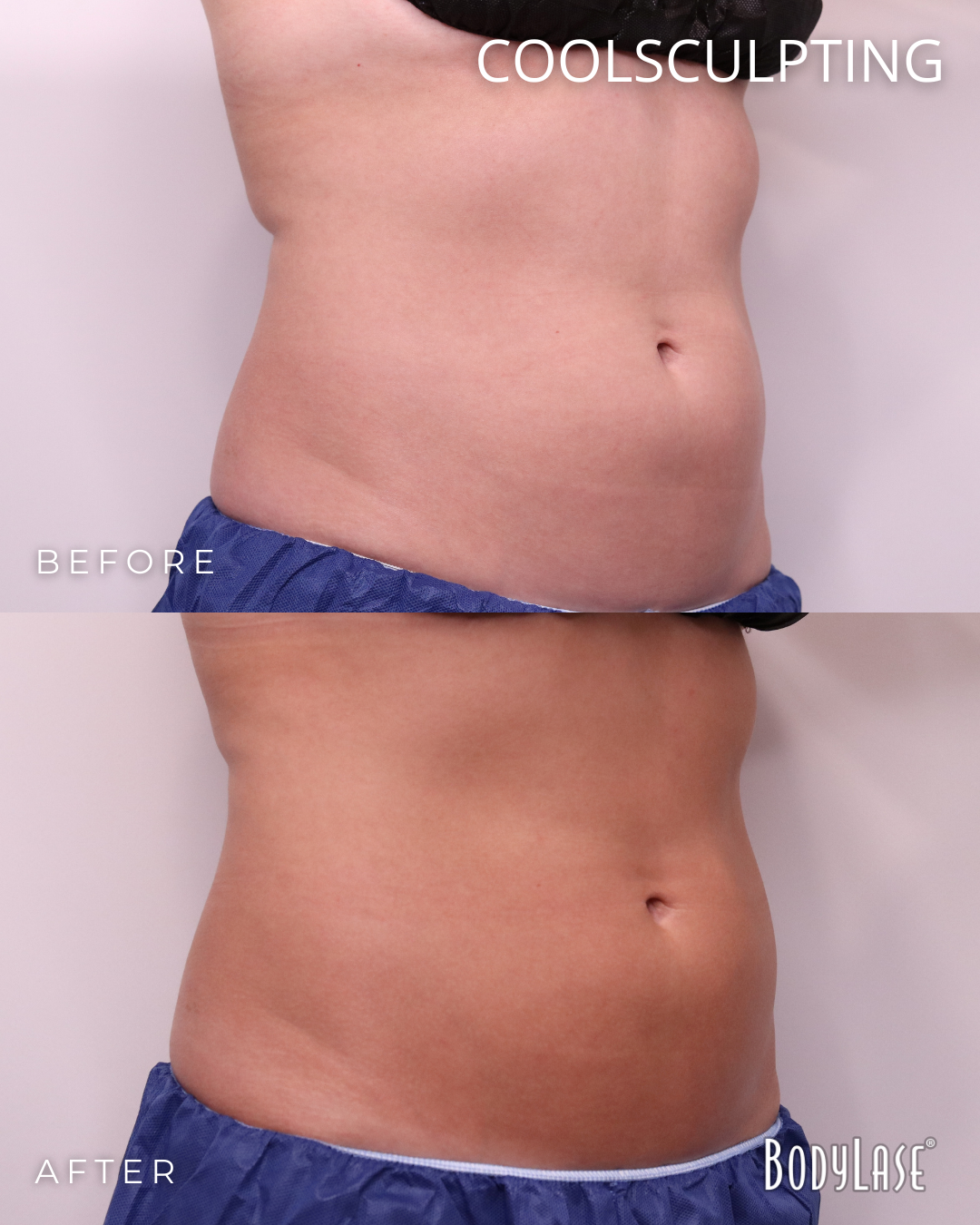 botox before & after