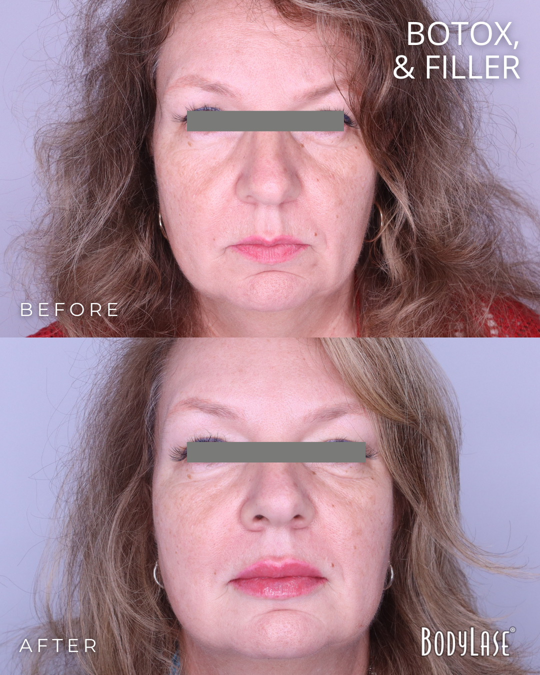 botox before & after