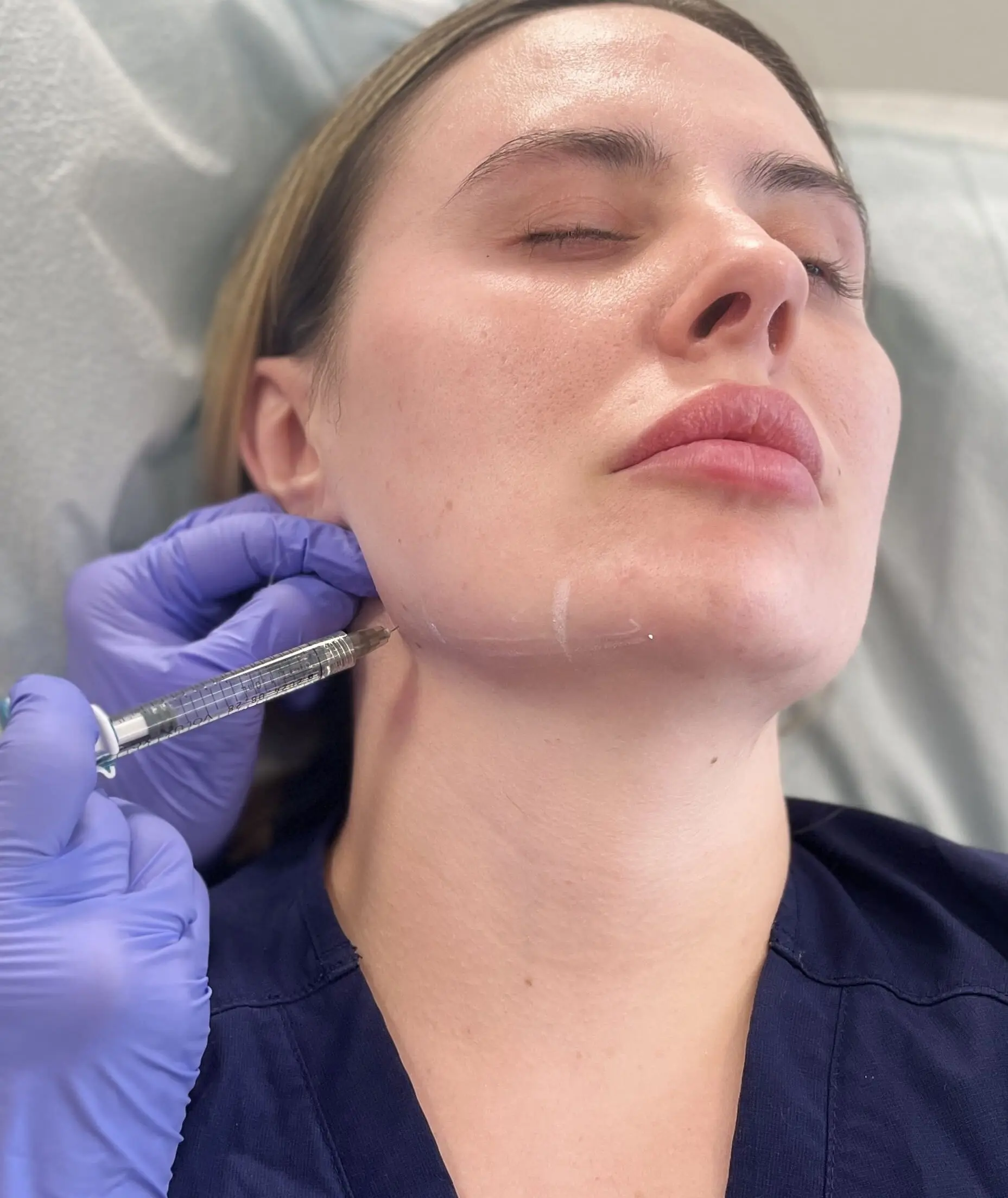 Dermal Filler