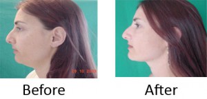 Before and after chin results